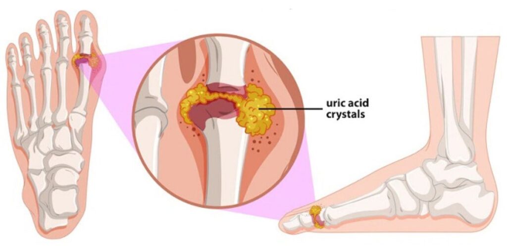 Uric Acid