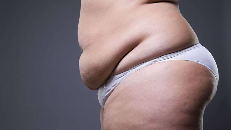 Lipedema